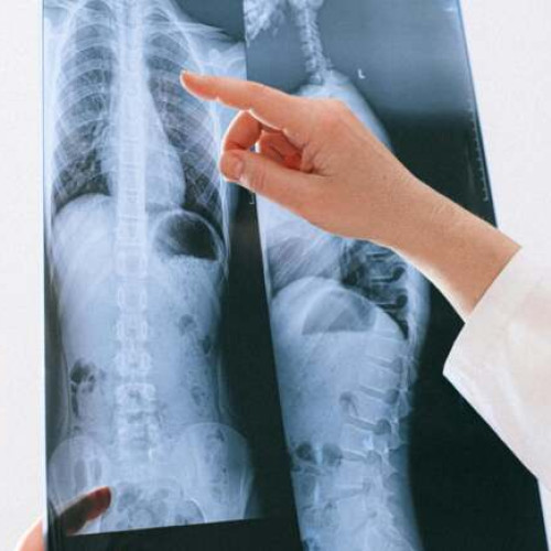 1 august - Ziua Mondială de Luptă Împotriva Cancerului Pulmonar. Medicii timișoreni trag un semnal de alarmă