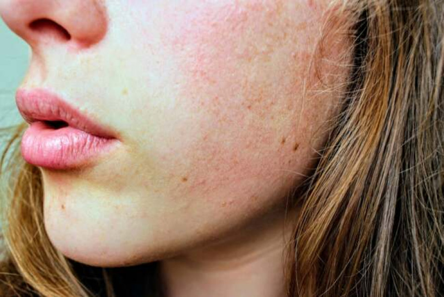 Dermatita atopică: factori de risc și impactul mediului
