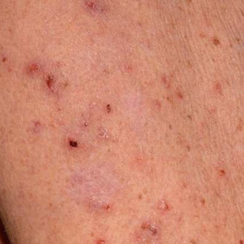 Infestarea cu râie, o problemă contagioasă: medicii trag un semnal de alarmă