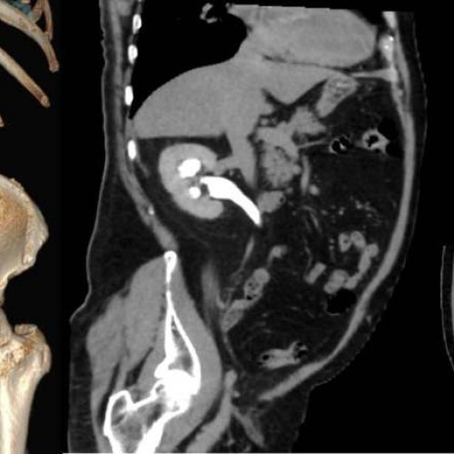 URO-CT gratuit, investigație la Spitalul Victor Babeș Timișoara: imagini detaliate pentru problemele tractului urinar